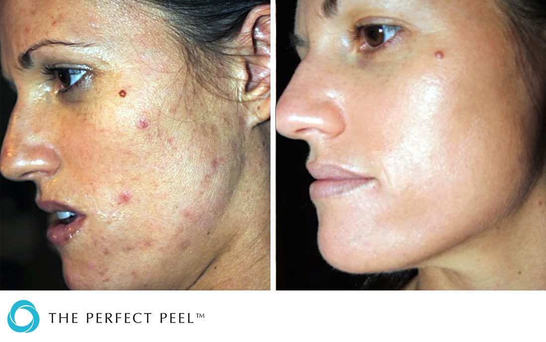 The Perfect Peel® | Renew Medical Aesthetics - Cheshire Clinic