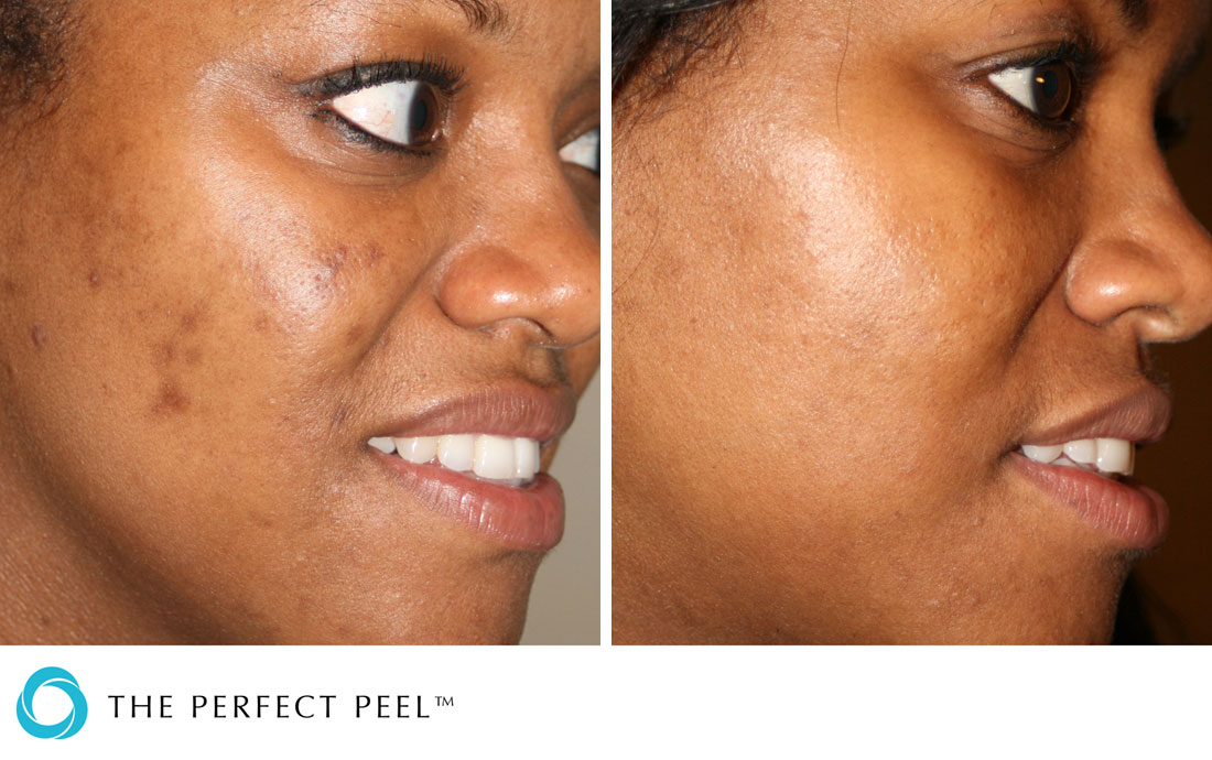 chemical-peels-perfect-peel-renew-medical-aesthetics-cheshire