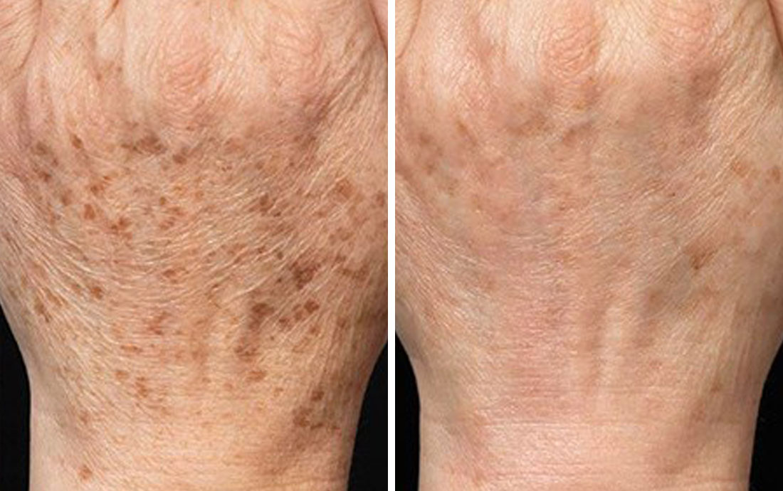 Age Spots On Hands Laser Treatment