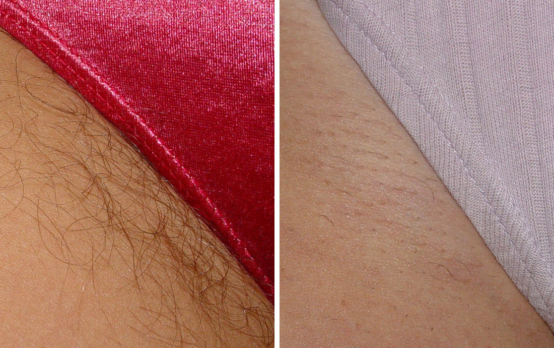 Ipl Hair Removal For Pubic Area Beauty Health