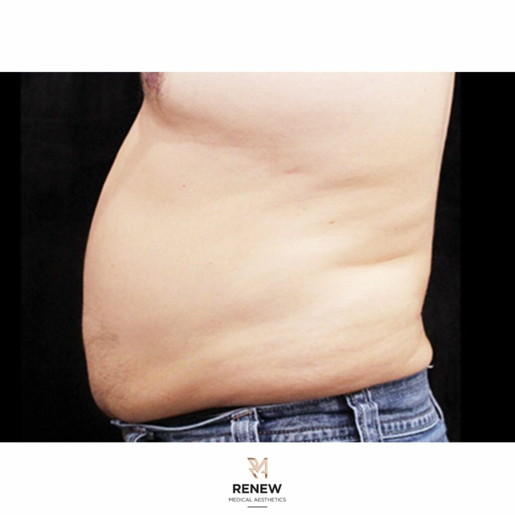 Non Surgical Fat Reduction Cheshire Clinic Renew Medical Aesthetics