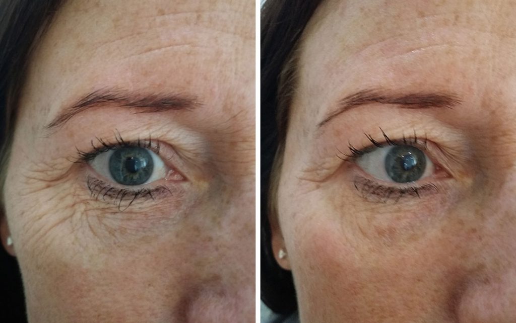 Viora Reaction Radiofrequency Skin Tightening Eyes Renew Medical Aesthetics Cheshire Clinic 