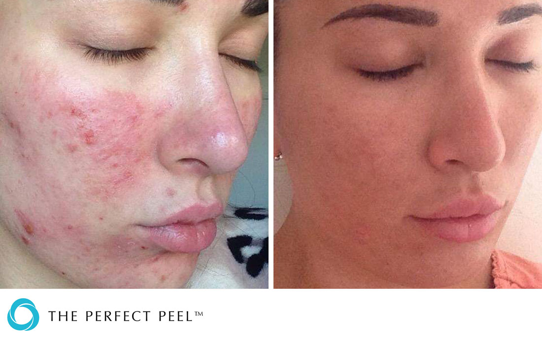 Chemical Peels, The Perfect Peel, before and after, severe acne skin