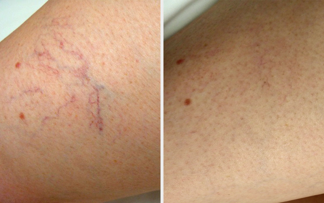 Injection Compression Sclerotherapy, leg vein removal, before and after