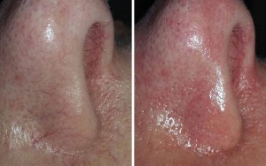Thermavein, red vein removal, nose before and after