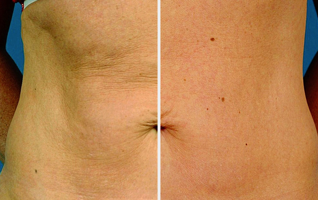 All You Need to Know About Radio Frequency Skin Tightening