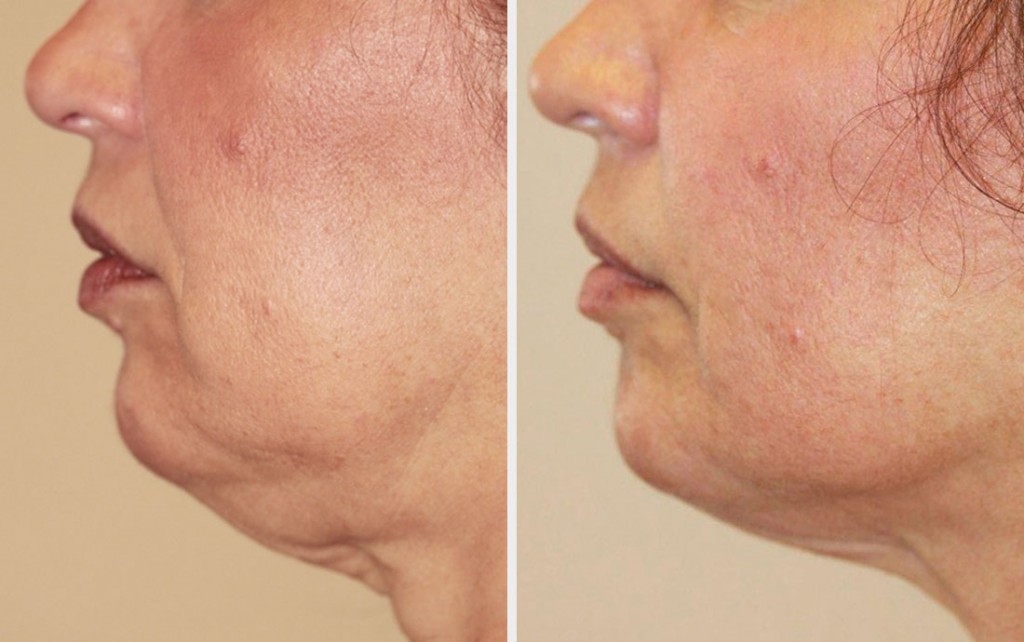 Viora Reaction, radiofrequency skin tightening, neck, before and after, 6 t...