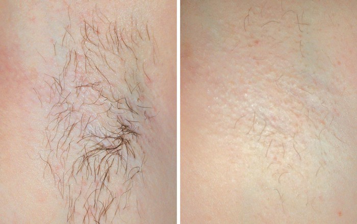 Laser Hair Removal Cheshire | Renew Medical Aesthetics