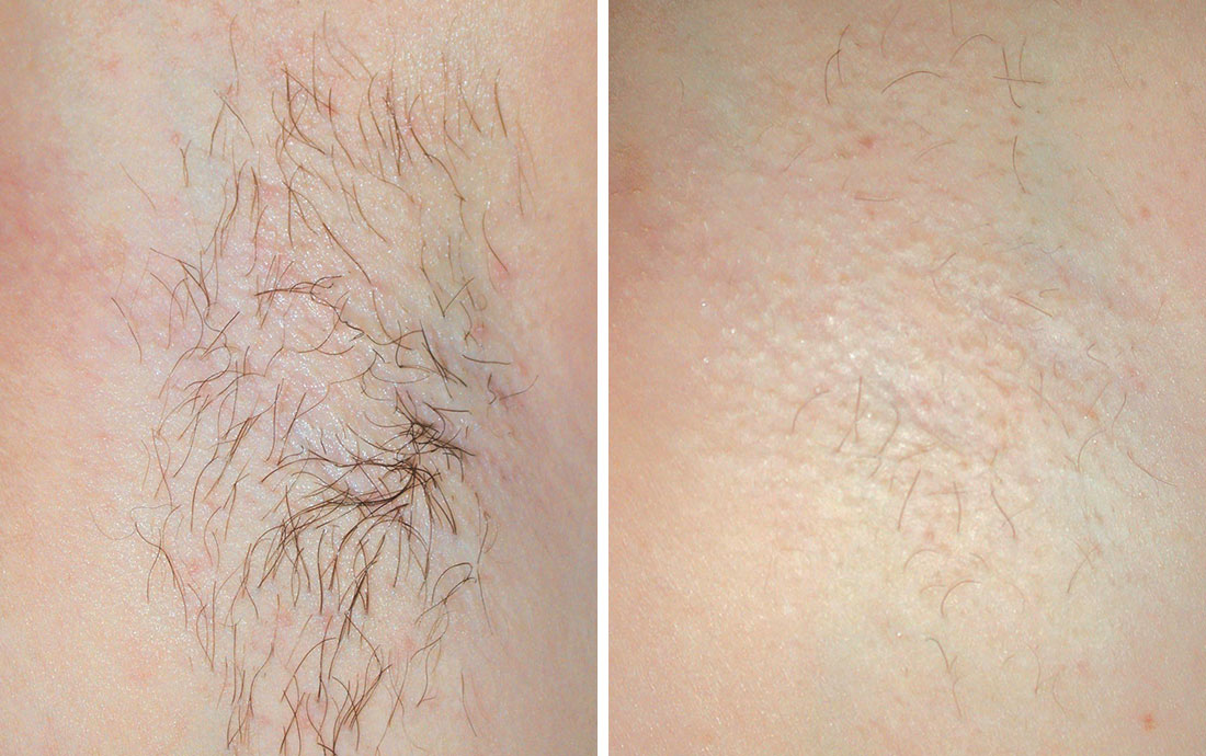 Laser Hair Removal Cheshire Renew Medical Aesthetics 