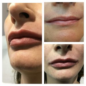Renew Medical Aesthetics, 4D Lips, 2 stage lip augmentation treatment
