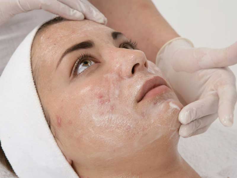 The Red Facial | Medical Aesthetics - Cheshire