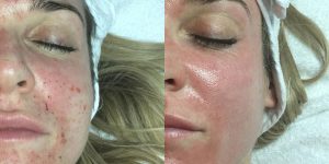 Renew Medical Aesthetics, Opera LED Light Therapy Mask, before and after results