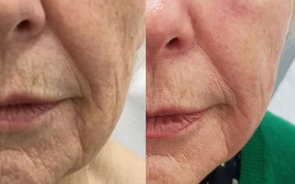 Facelift In 5 Renew Medical Aesthetics Cheshire Clinic