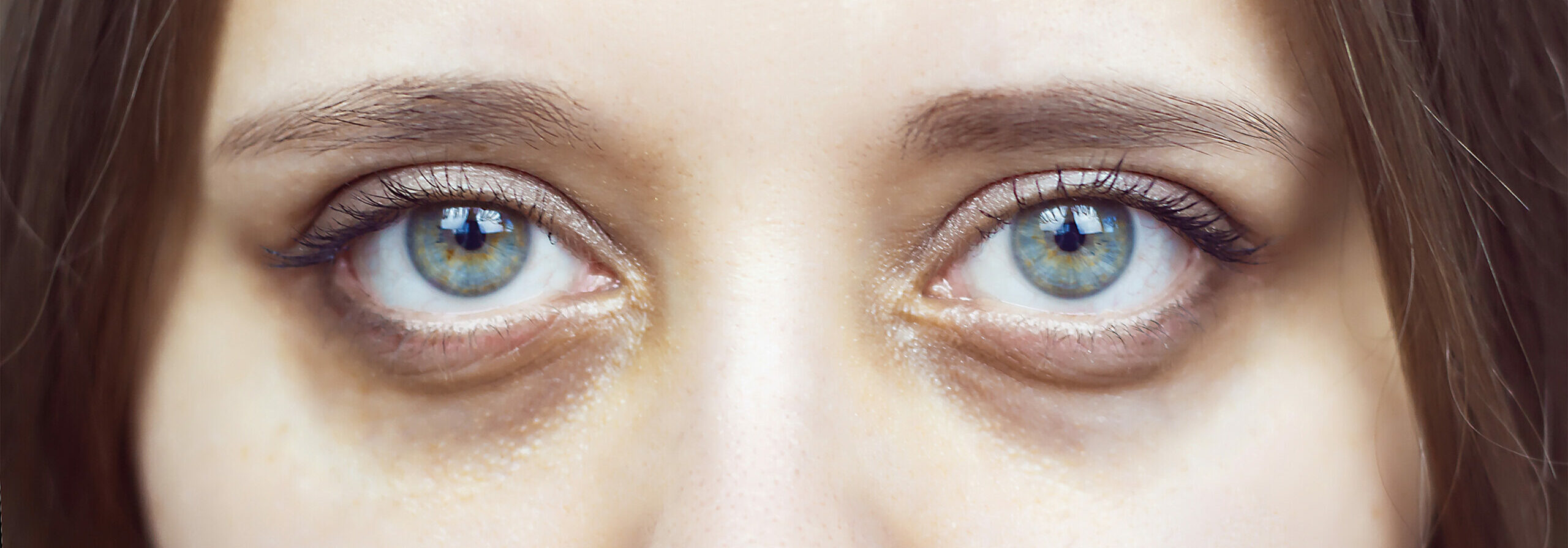 What causes dark circles under eyes | How to get rid of dark circles