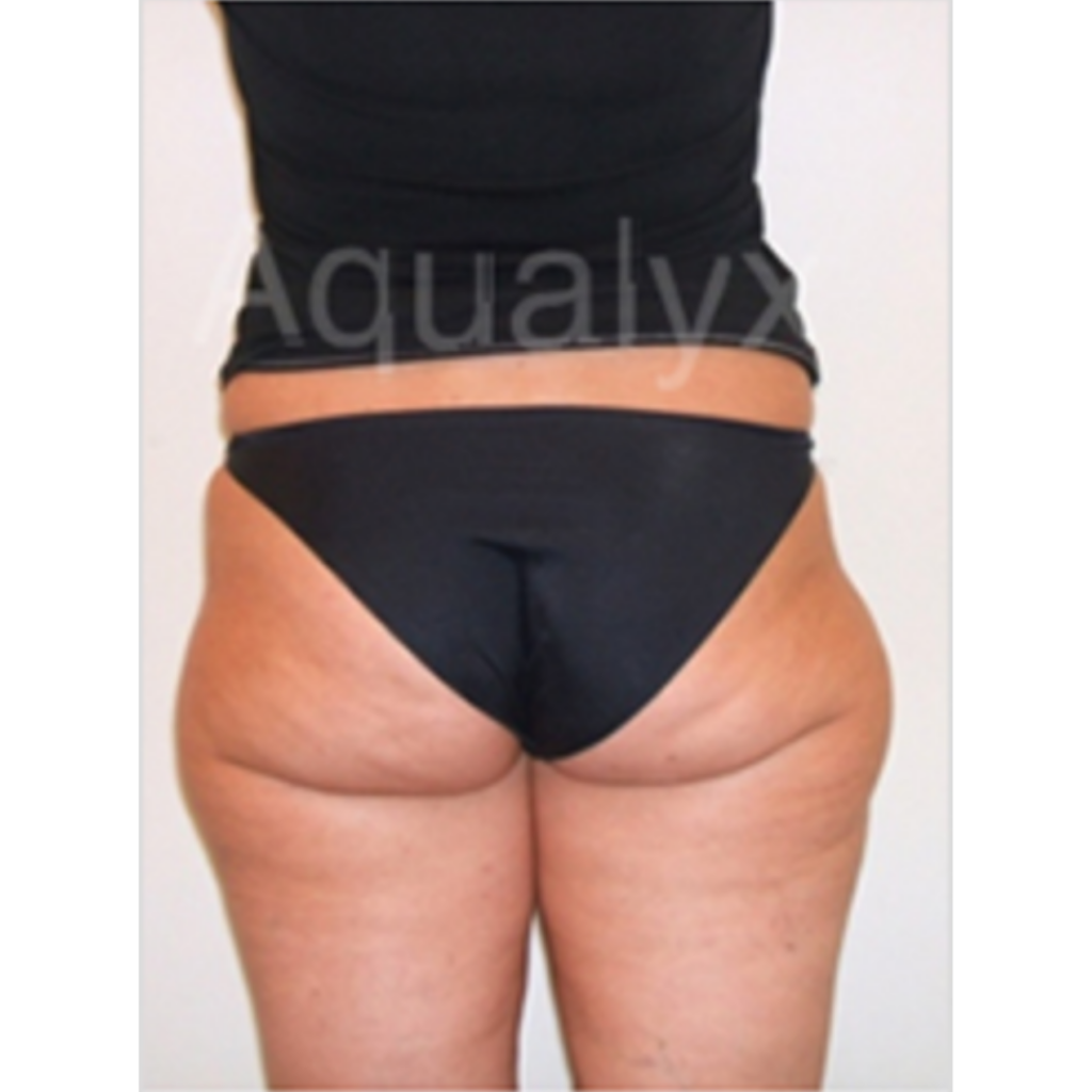 Fat Dissolving Injections Cheshire Clinic Renew Medical Aesthetics