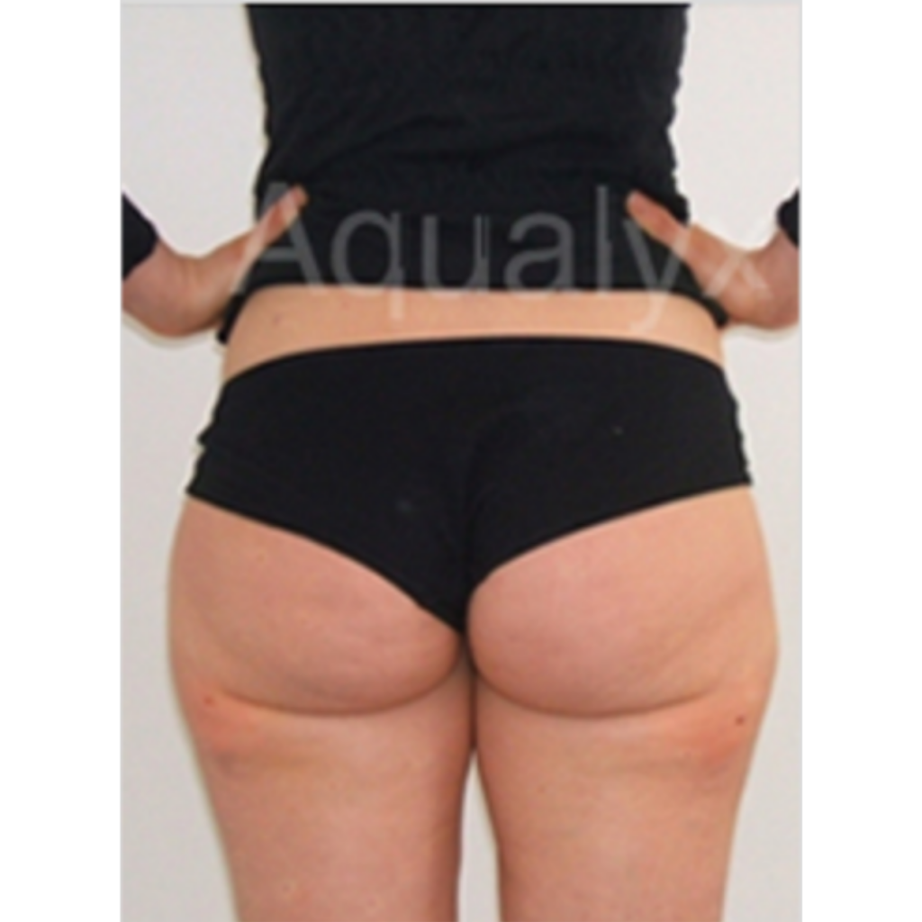 Fat Dissolving Injections Cheshire Clinic Renew Medical Aesthetics